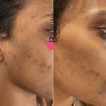 microneedling av:ap barkhallah