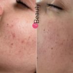 sako microneedling 1